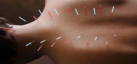 acupuncture